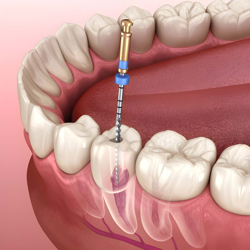 root canal treatment near you