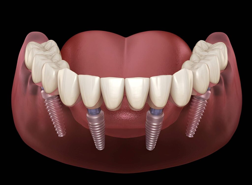teethxpress same-day implants near you