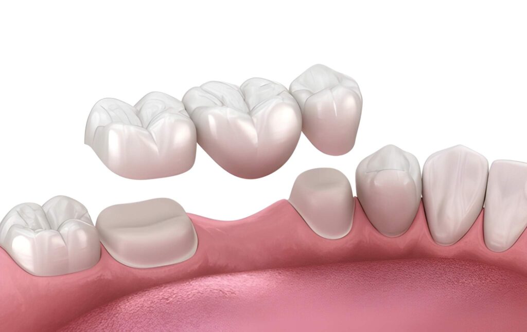 zirconia fixed bridges near you